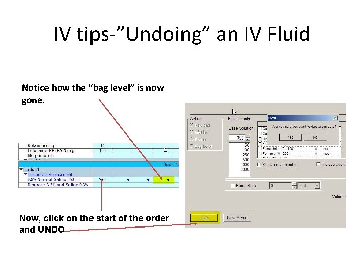 IV tips-”Undoing” an IV Fluid Notice how the “bag level” is now gone. Now,