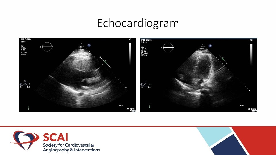 Echocardiogram 