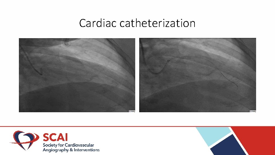 Cardiac catheterization 