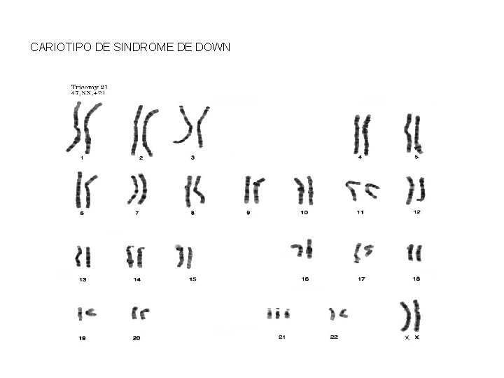 CARIOTIPO DE SINDROME DE DOWN 