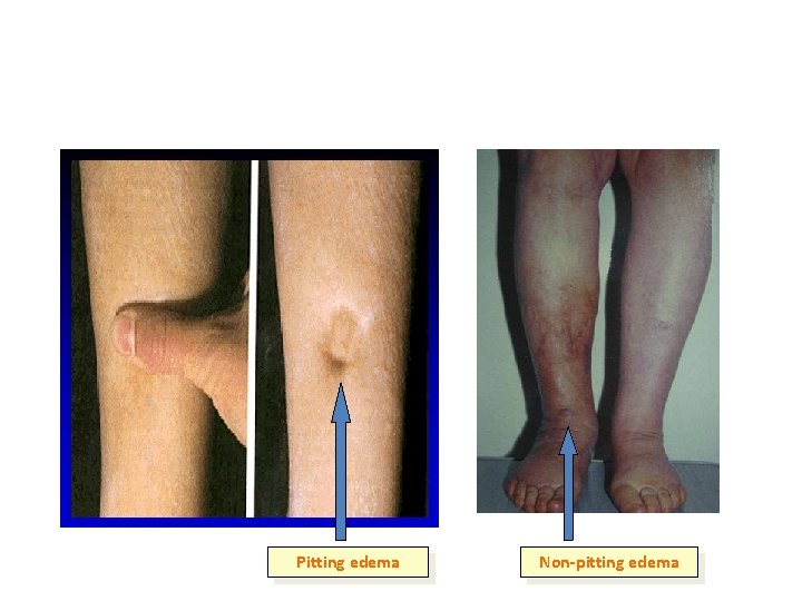 Edema Pitting edema Non-pitting edema Edema Pitting edema Non-pitting edema