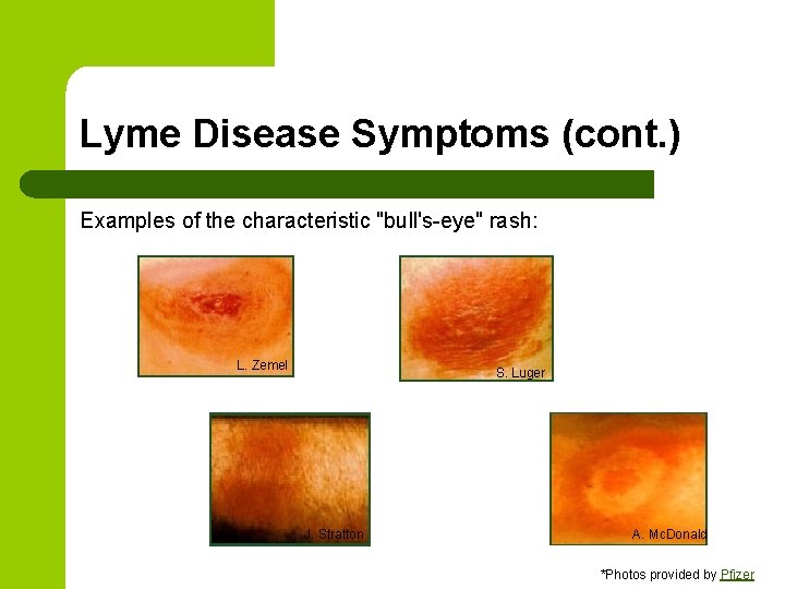 Lyme Disease Symptoms (cont. ) Examples of the characteristic "bull's-eye" rash: L. Zemel S. Lyme Disease Symptoms (cont. ) Examples of the characteristic "bull's-eye" rash: L. Zemel S.