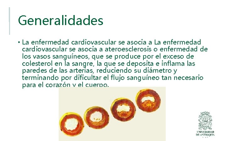 Generalidades • La enfermedad cardiovascular se asocia a ateroesclerosis o enfermedad de los vasos