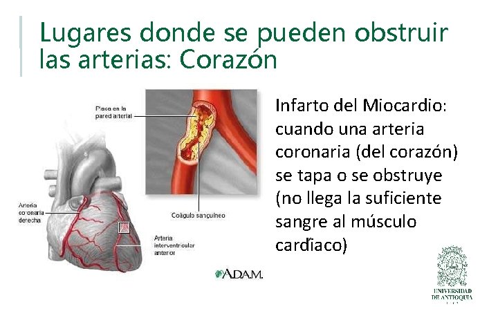 Lugares donde se pueden obstruir las arterias: Corazón Infarto del Miocardio: cuando una arteria