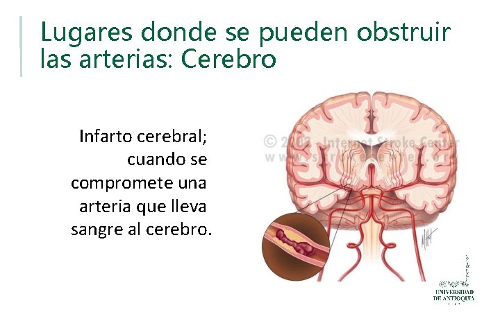 Lugares donde se pueden obstruir las arterias: Cerebro Infarto cerebral; cuando se compromete una