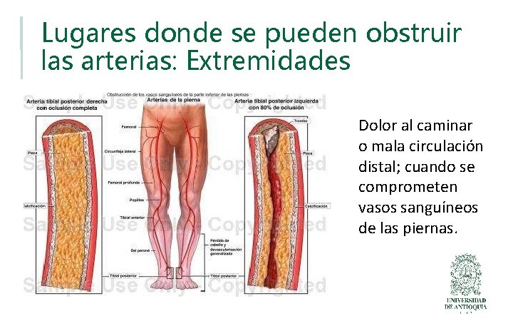 Lugares donde se pueden obstruir las arterias: Extremidades Dolor al caminar o mala circulación