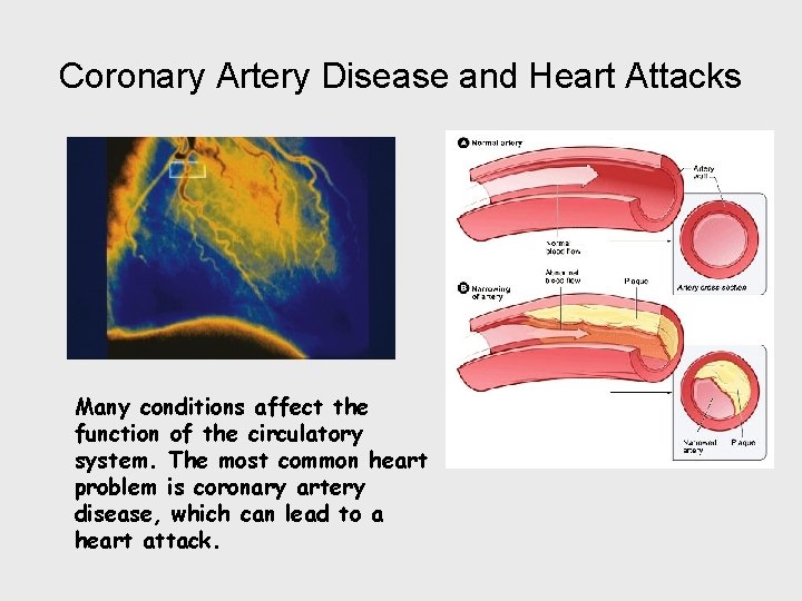 Coronary Artery Disease and Heart Attacks Many conditions affect the function of the circulatory