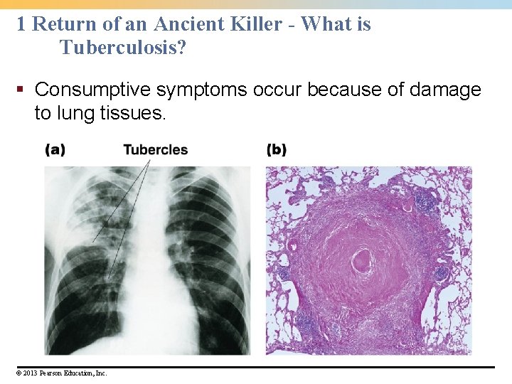 1 Return of an Ancient Killer - What is Tuberculosis? § Consumptive symptoms occur