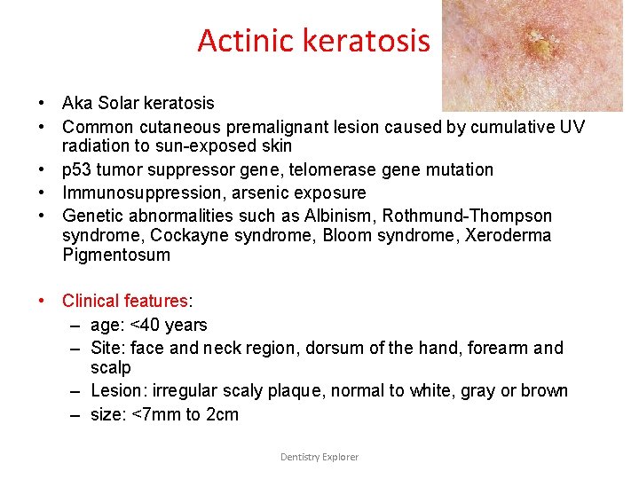 Actinic keratosis • Aka Solar keratosis • Common cutaneous premalignant lesion caused by cumulative