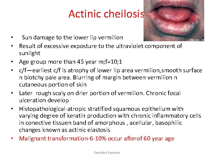 Actinic cheilosis • Sun damage to the lower lip vermilion • Result of excessive