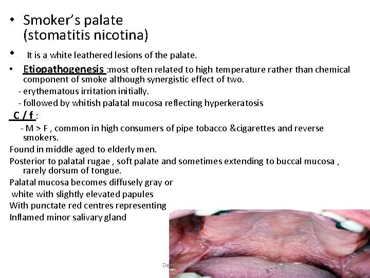  • Smoker’s palate (stomatitis nicotina) • It is a white leathered lesions of