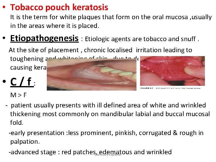  • Tobacco pouch keratosis It is the term for white plaques that form