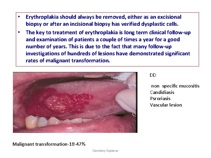  • Erythroplakia should always be removed, either as an excisional biopsy or after