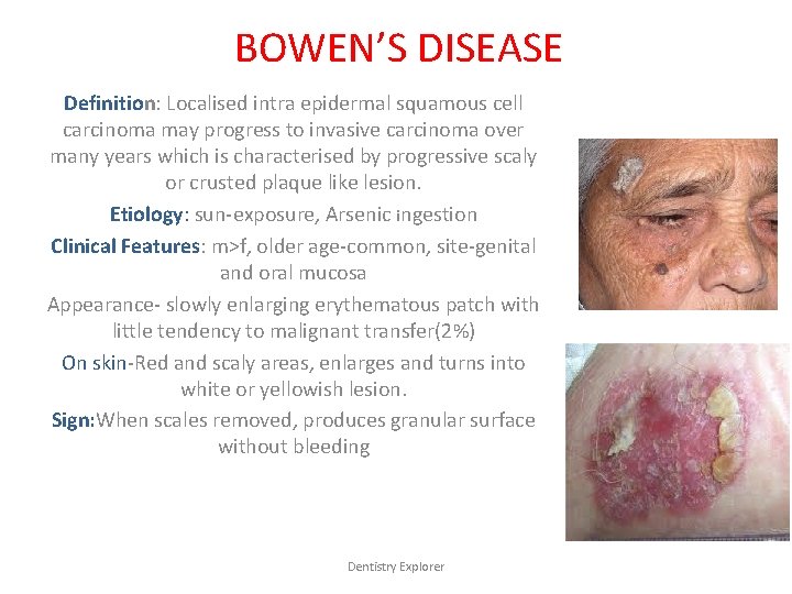 BOWEN’S DISEASE Definition: Localised intra epidermal squamous cell carcinoma may progress to invasive carcinoma