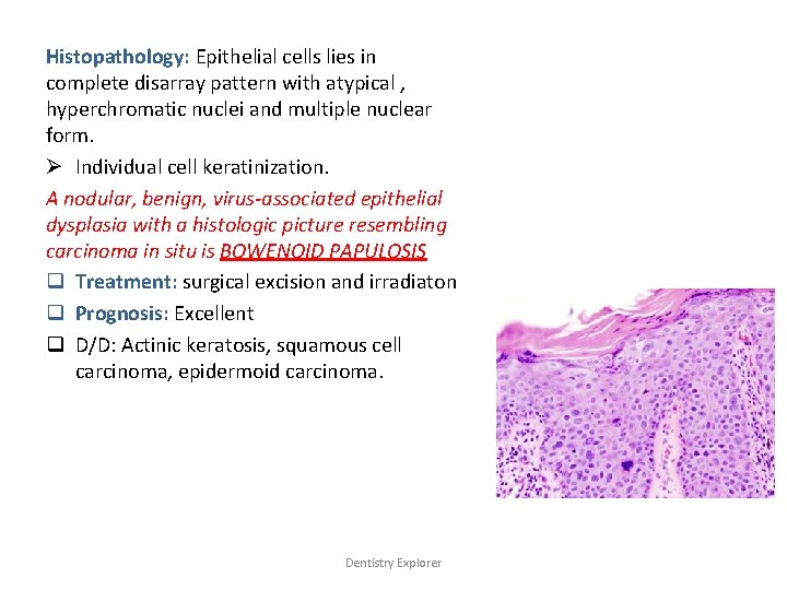 Histopathology: Epithelial cells lies in complete disarray pattern with atypical , hyperchromatic nuclei and
