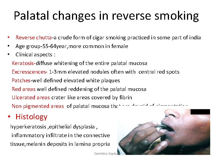 Palatal changes in reverse smoking • Reverse chutta-a crude form of cigar smoking practiced