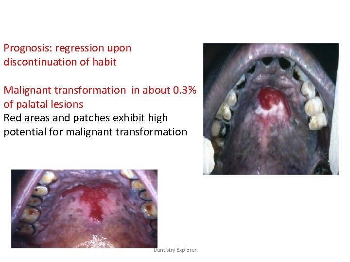 Prognosis: regression upon discontinuation of habit Malignant transformation in about 0. 3% of palatal