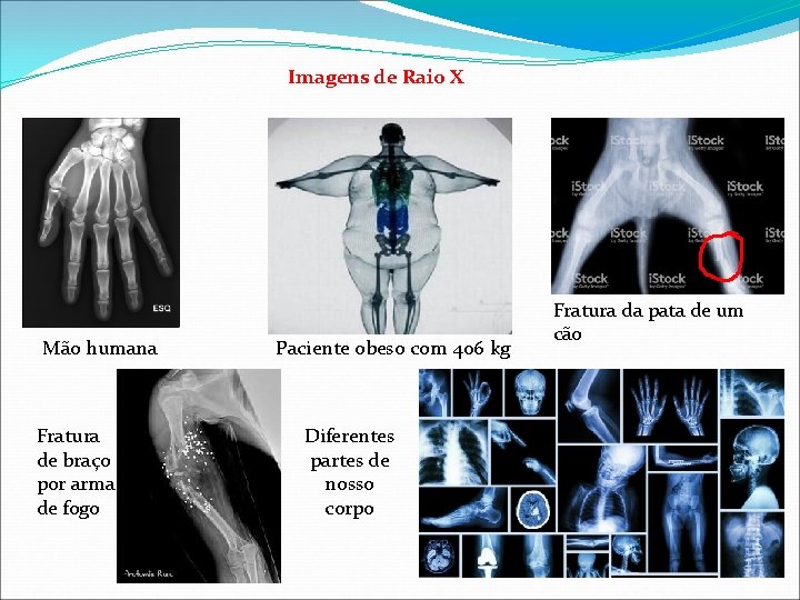 Imagens de Raio X Mão humana Fratura de braço por arma de fogo Paciente