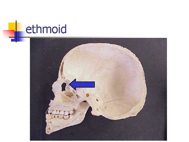 ethmoid 