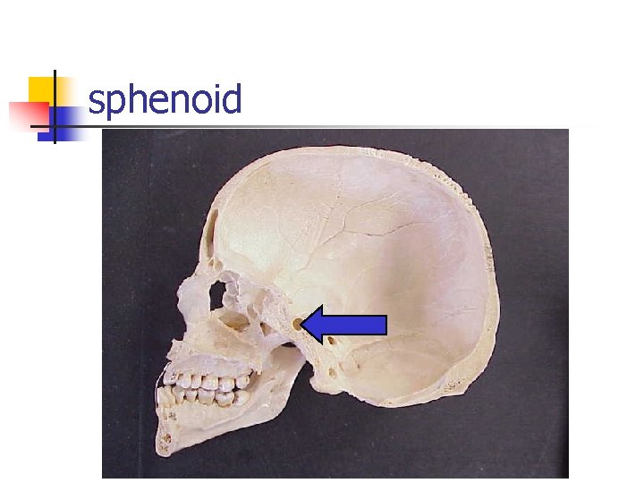 sphenoid 