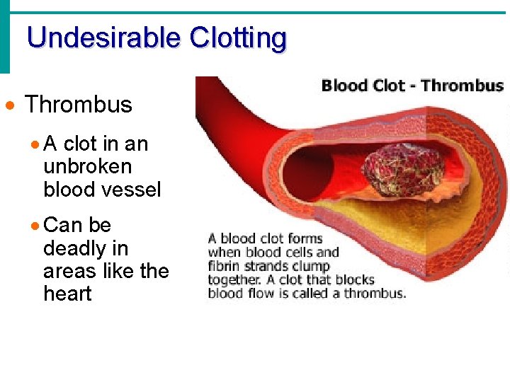 Undesirable Clotting · Thrombus · A clot in an unbroken blood vessel · Can