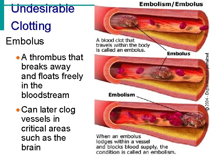 Undesirable Clotting Embolus · A thrombus that breaks away and floats freely in the