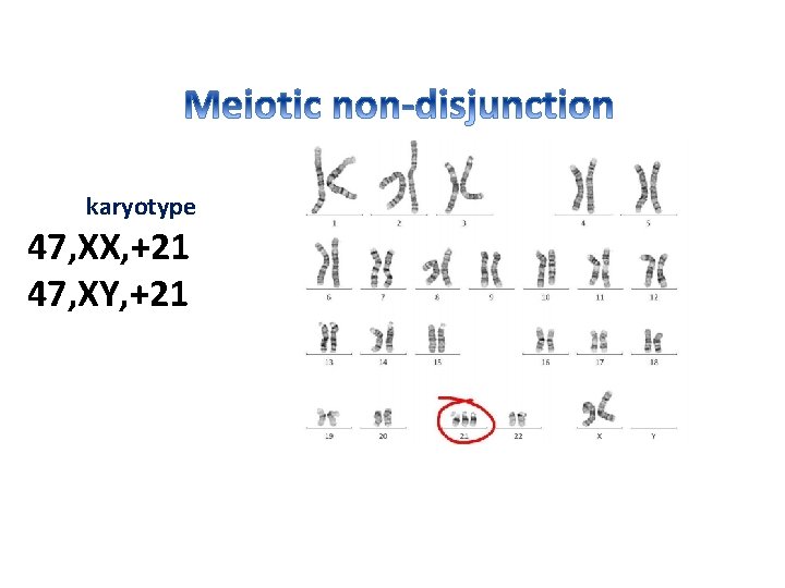 karyotype 47, XX, +21 47, XY, +21 