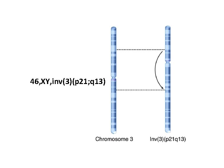 46, XY, inv(3)(p 21; q 13) 