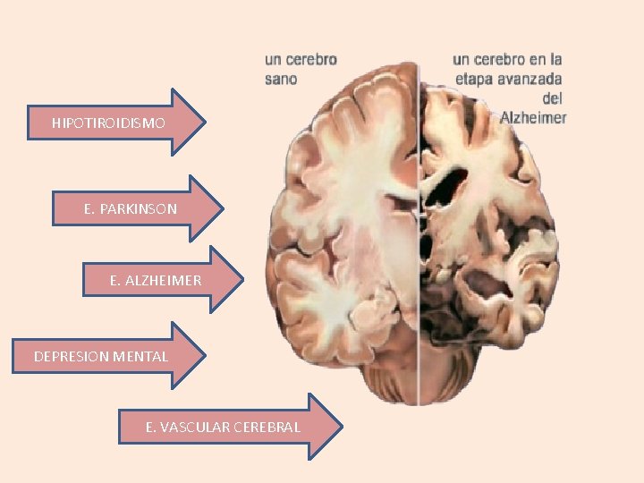 HIPOTIROIDISMO E. PARKINSON E. ALZHEIMER DEPRESION MENTAL E. VASCULAR CEREBRAL HIPOTIROIDISMO E. PARKINSON E. ALZHEIMER DEPRESION MENTAL E. VASCULAR CEREBRAL