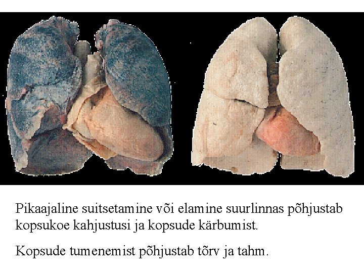 Pikaajaline suitsetamine või elamine suurlinnas põhjustab kopsukoe kahjustusi ja kopsude kärbumist. Kopsude tumenemist põhjustab