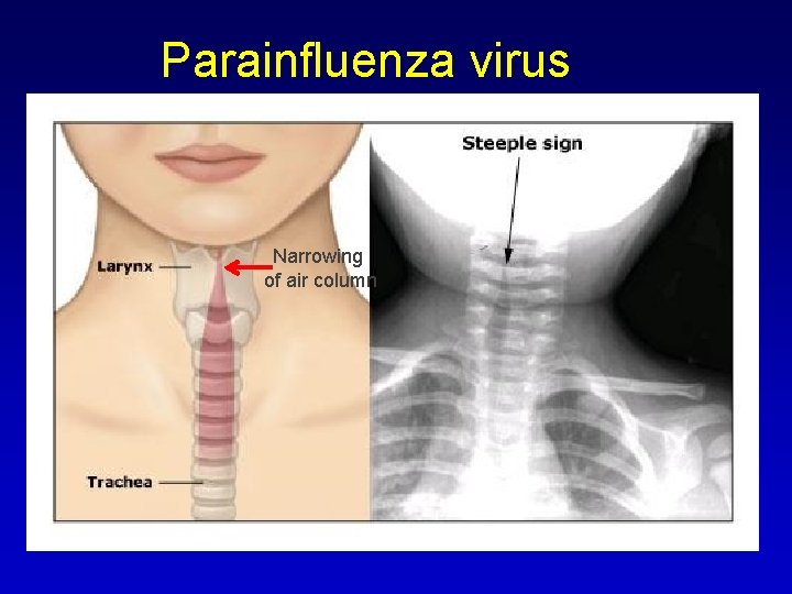 Parainfluenza virus Narrowing of air column 