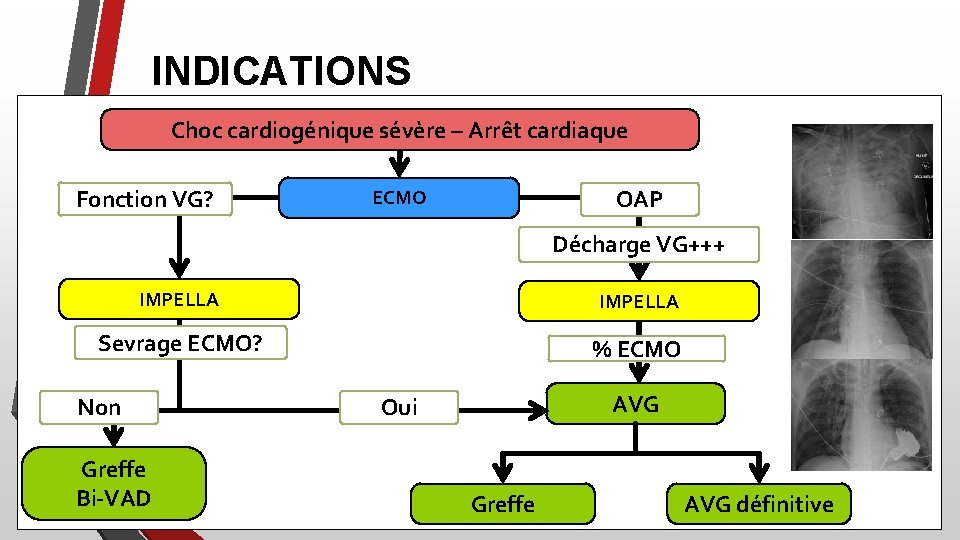 INDICATIONS Choc cardiogénique sévère – Arrêt cardiaque Fonction VG? OAP ECMO Décharge VG+++ IMPELLA
