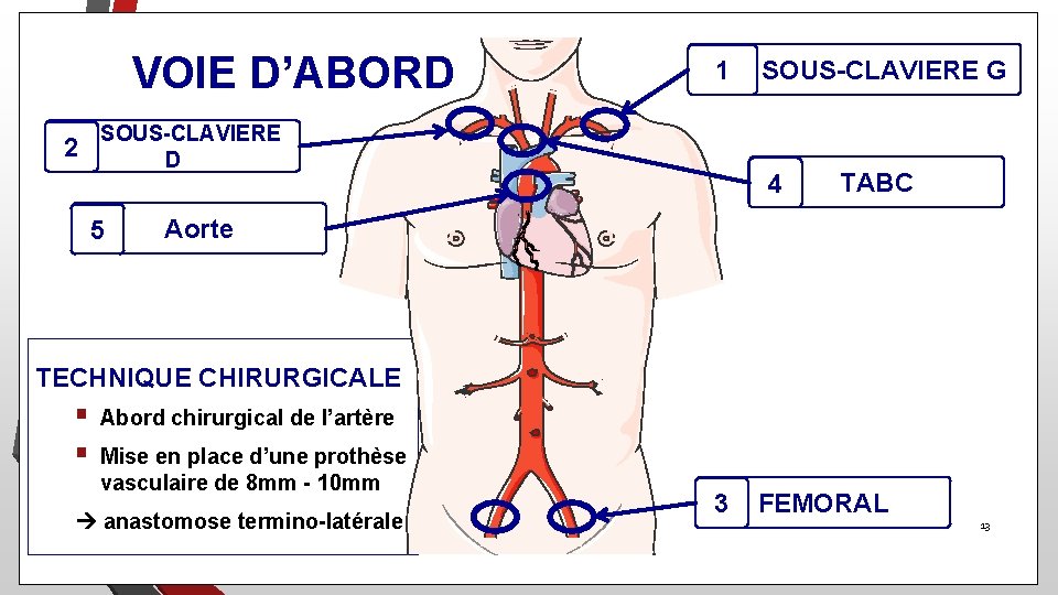 VOIE D’ABORD SOUS-CLAVIERE G 1 SOUS-CLAVIERE 2 D 5 4 TABC Aorte TECHNIQUE CHIRURGICALE