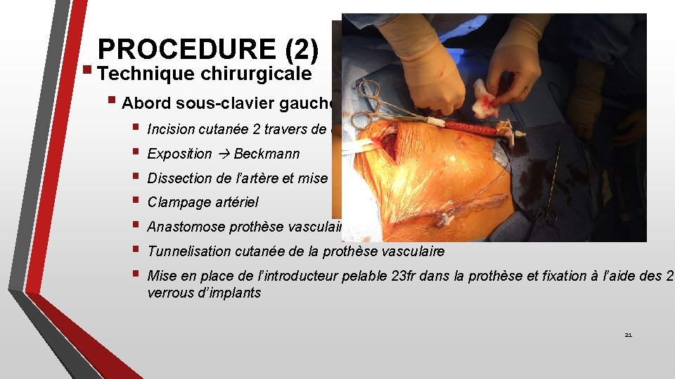 PROCEDURE (2) § Technique chirurgicale § Abord sous-clavier gauche § § § § Incision