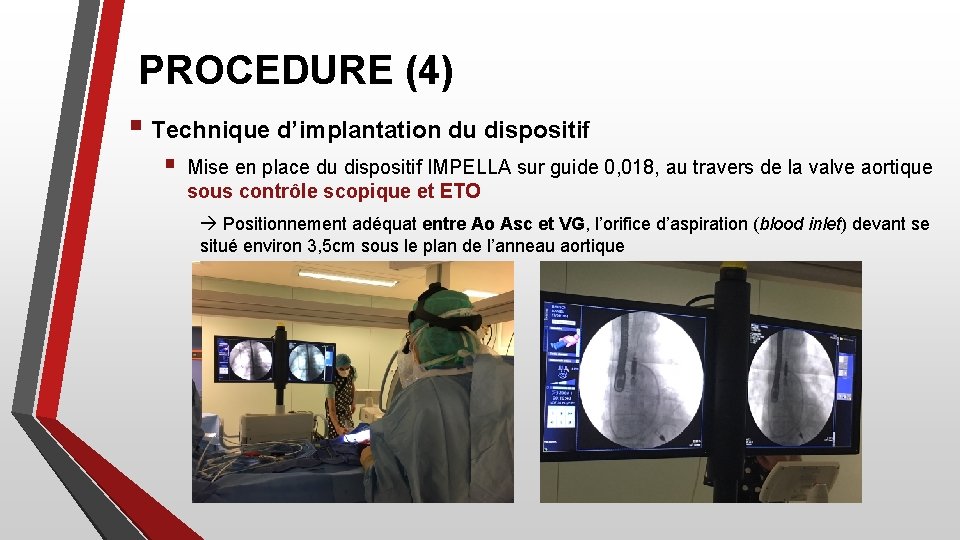 PROCEDURE (4) § Technique d’implantation du dispositif § Mise en place du dispositif IMPELLA