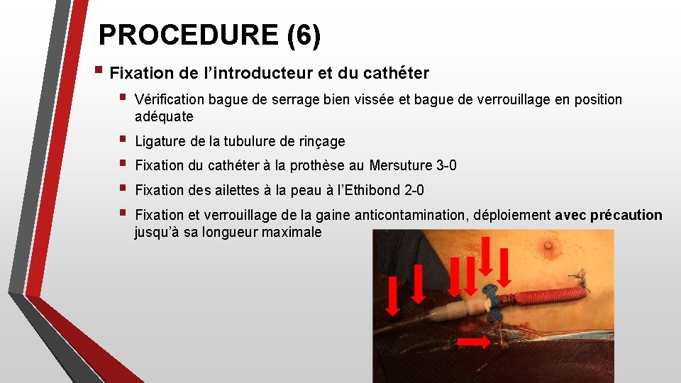 PROCEDURE (6) § Fixation de l’introducteur et du cathéter § Vérification bague de serrage