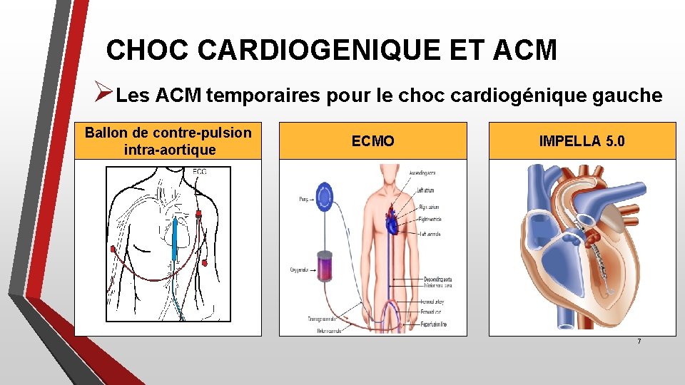 CHOC CARDIOGENIQUE ET ACM ØLes ACM temporaires pour le choc cardiogénique gauche Ballon de