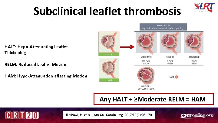 Subclinical leaflet thrombosis HALT: Hypo-Attenuating Leaflet Thickening RELM: Reduced Leaflet Motion HAM: Hypo-Attenuation affecting