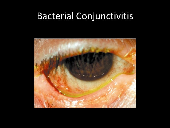 Bacterial Conjunctivitis http: //images. search. yahoo. com/search/images? p=bacterial+conjunctivitis+treatment&rs=0 &_adv_prop=images&vf=all&ei=UTF-8&vf= 