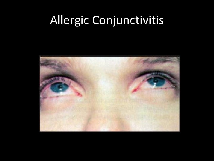 Allergic Conjunctivitis http: //images. search. yahoo. com/search/images? _adv_prop=images&imgsz=all&imgc=&vf=all&va=al lergic+conjunctivitis&fr=yfp-t-410&ei=UTF-8 