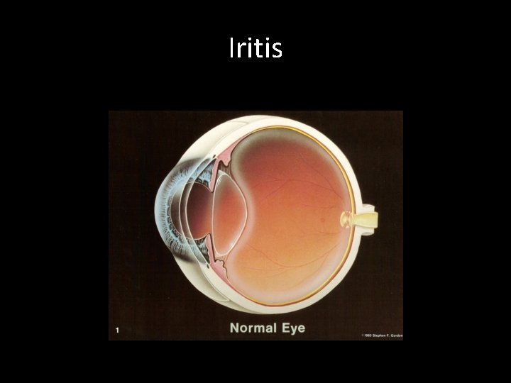 Iritis 