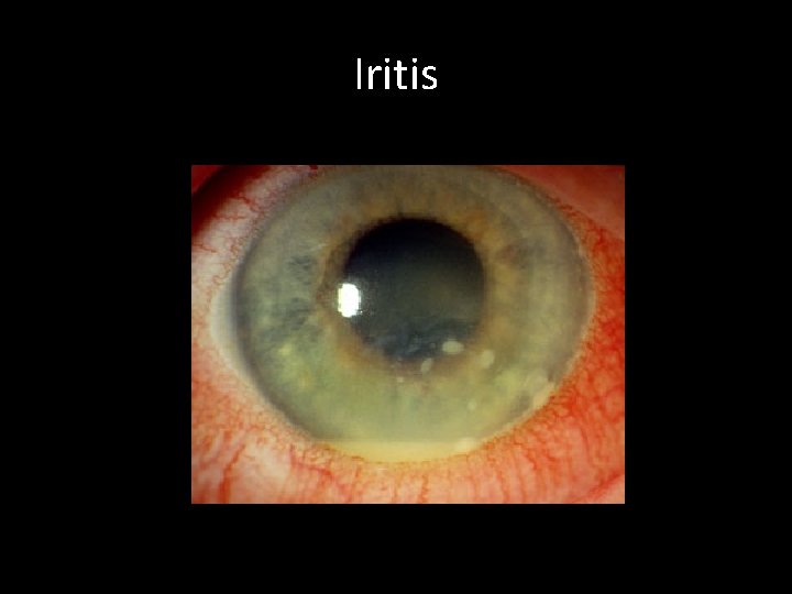 Iritis http: //images. search. yahoo. com/search/images? _adv_prop=images&imgsz=all&imgc=&vf=all& va=iritis&fr=yfp-t-410&ei=UTF-8 