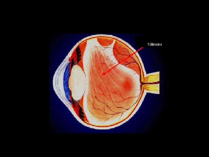 Posterior Vitreous Detachment http: //www. avclinic. com/images/PVD. jpg 