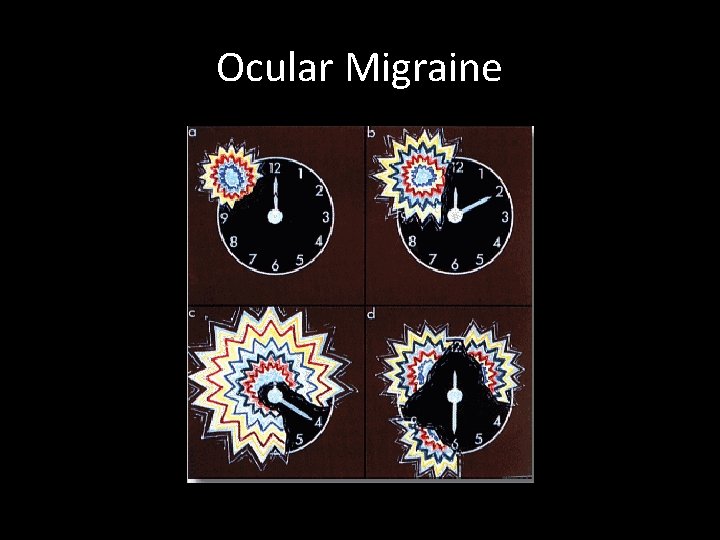 Ocular Migraine 