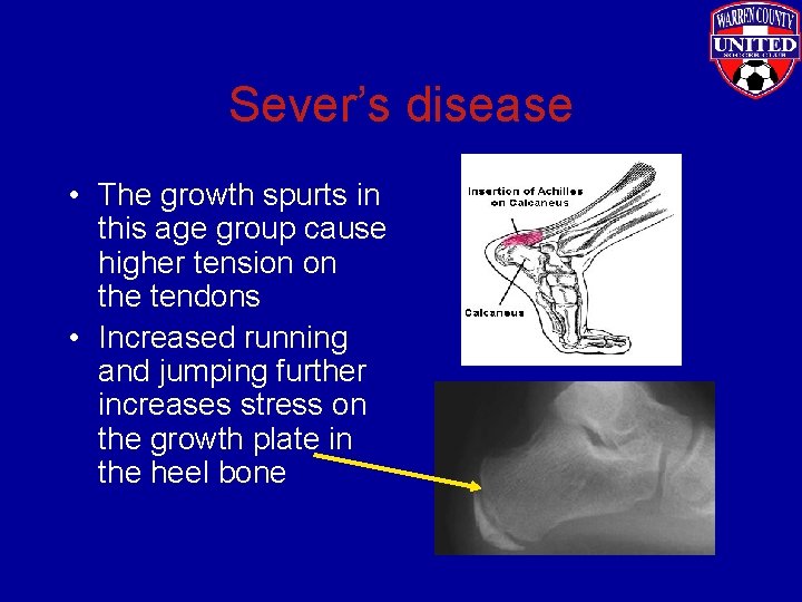 Sever’s disease • The growth spurts in this age group cause higher tension on