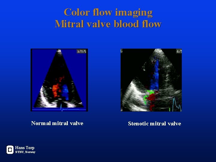 Color flow imaging Mitral valve blood flow Normal mitral valve Hans Torp NTNU, Norway