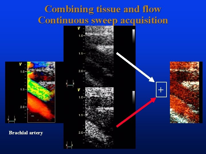 Combining tissue and flow Continuous sweep acquisition + Brachial artery 