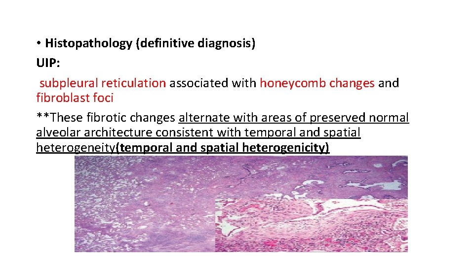  • Histopathology (definitive diagnosis) UIP: subpleural reticulation associated with honeycomb changes and fibroblast