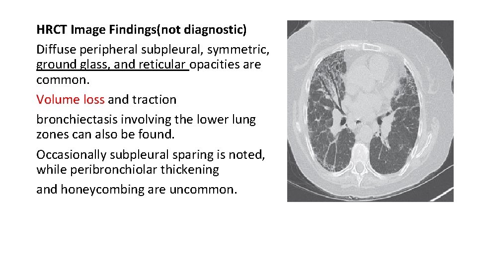 HRCT Image Findings(not diagnostic) Diffuse peripheral subpleural, symmetric, ground glass, and reticular opacities are