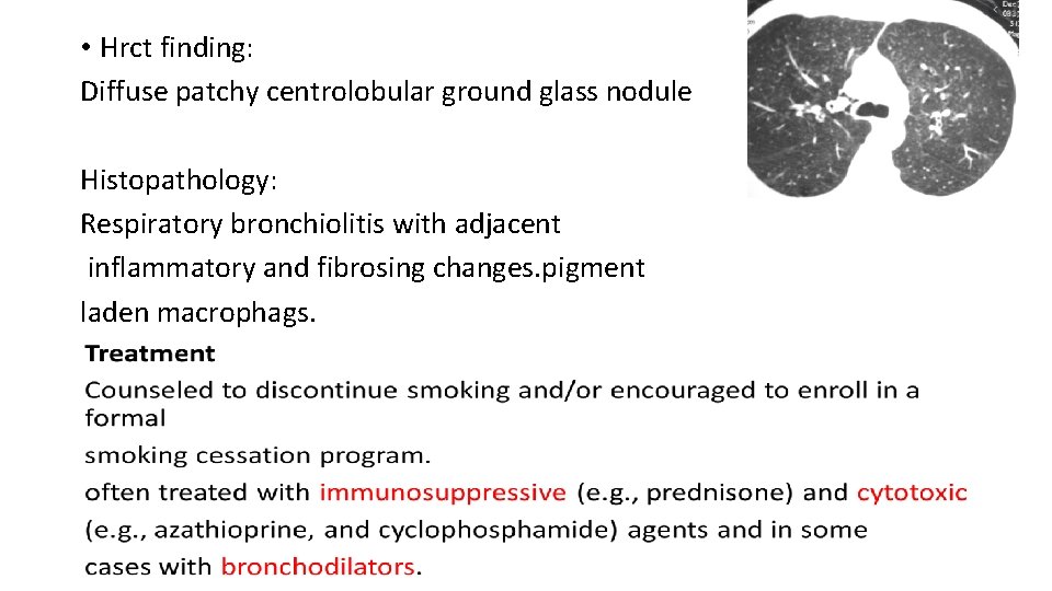  • Hrct finding: Diffuse patchy centrolobular ground glass nodule Histopathology: Respiratory bronchiolitis with